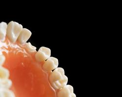 Jak wygląda implant zęba i ile kosztuje?