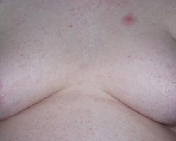Ginekomastia – powiększenie męskich piersi