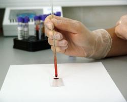 Choroby krwi: anemia, hemofilia, białaczka