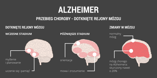 infografika - alzheimer