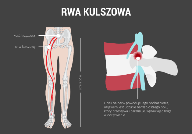 infografika - rwa kulszowa