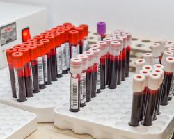 Bladość i częste infekcje mogą być objawem białaczki? 
